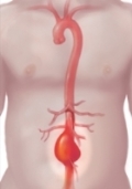 aneurysms