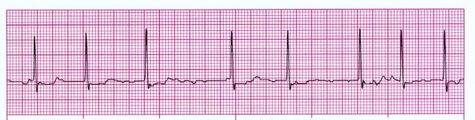 national-atrial-fibrillation-month